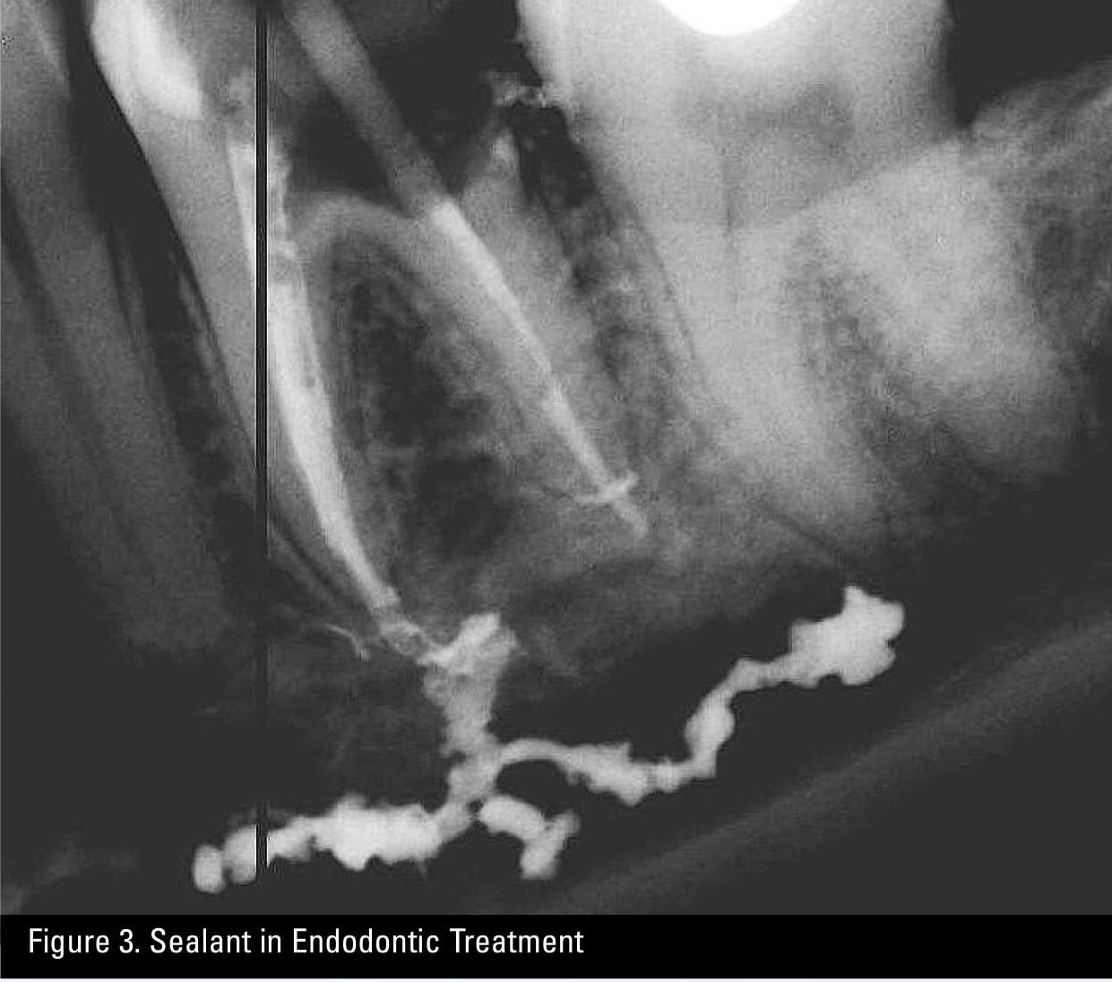 Sealant in Endodontic Treatment